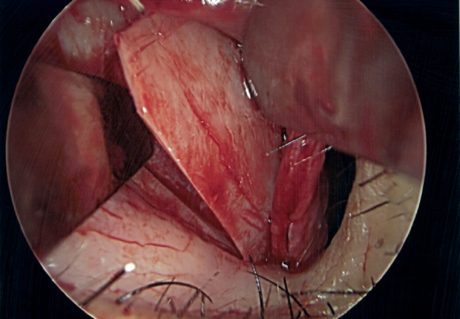 Septoplasty and Turbinate Surgery
