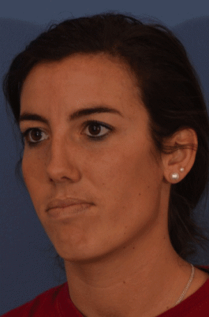 Rhinoplasty Case 3255 Before Photo Rhinoplasty
