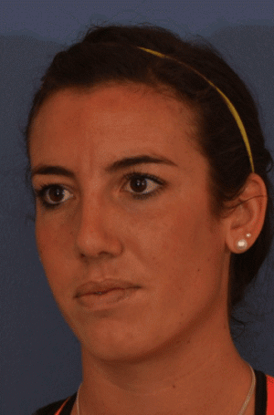 Rhinoplasty Case 3255 After Photo Rhinoplasty