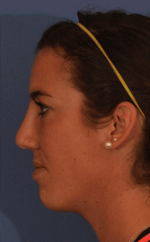 Rhinoplasty Case 3255 After Photo Rhinoplasty