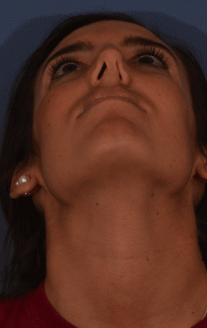 Rhinoplasty