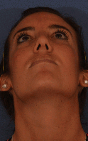 Rhinoplasty Case 3255 After Photo Rhinoplasty