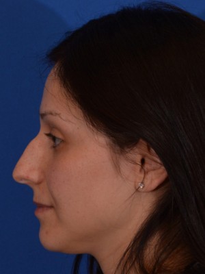 Rhinoplasty