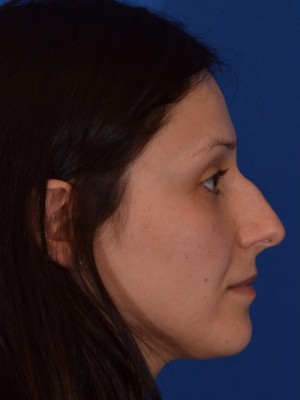 Rhinoplasty