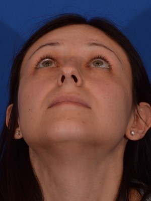 Rhinoplasty