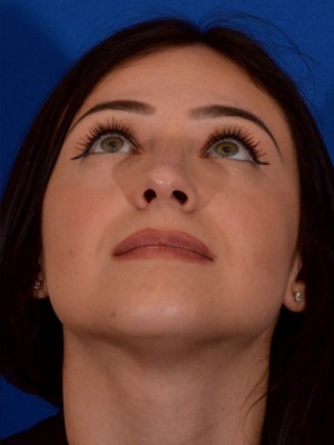 Rhinoplasty