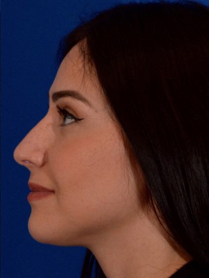 Rhinoplasty