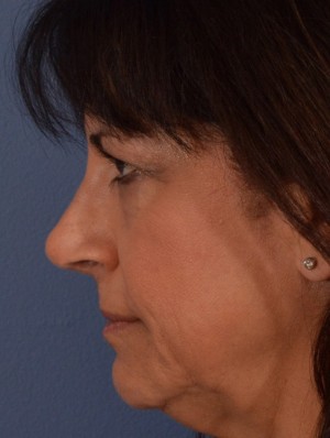 Rhinoplasty Case 3245 After Photo Rhinoplasty