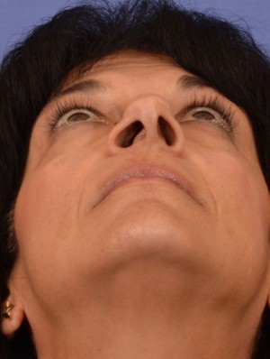 Rhinoplasty