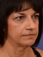 Rhinoplasty