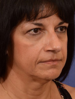 Rhinoplasty Case 3245 Before Photo Rhinoplasty