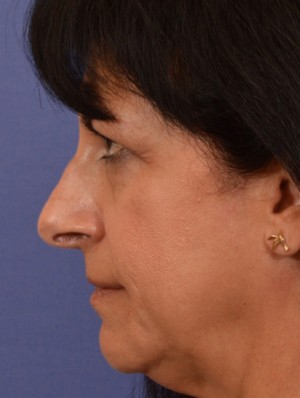 Rhinoplasty Case 3245 Before Photo Rhinoplasty