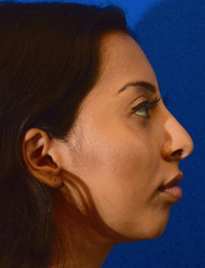 Rhinoplasty