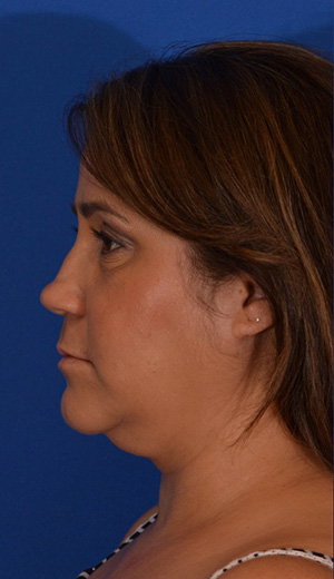 Revision Rhinoplasty