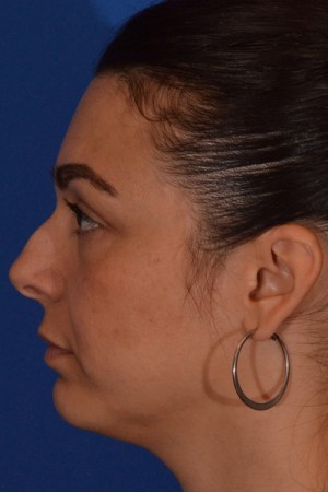 Rhinoplasty