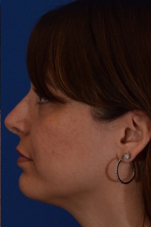 Rhinoplasty