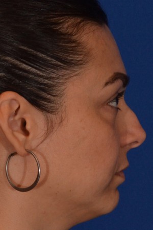 Rhinoplasty