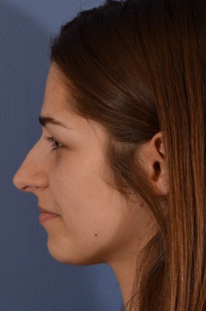 Rhinoplasty