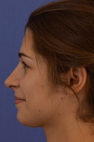 Rhinoplasty