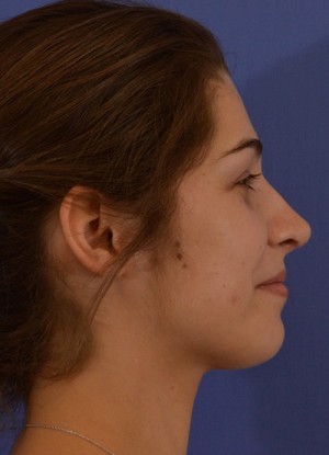 Rhinoplasty