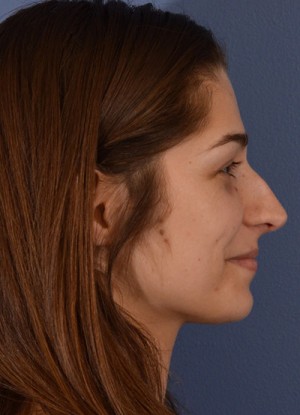 Rhinoplasty