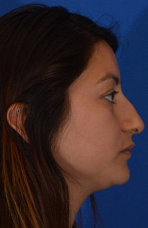 Rhinoplasty