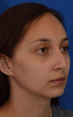 Rhinoplasty