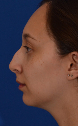 Rhinoplasty