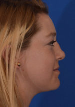 Rhinoplasty