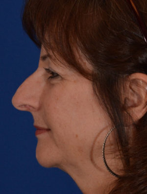 Rhinoplasty