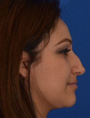 Rhinoplasty