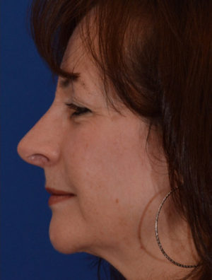 Rhinoplasty