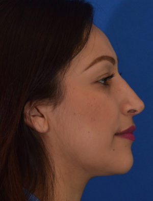 Rhinoplasty