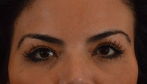 Blepharoplasty