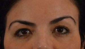 Blepharoplasty