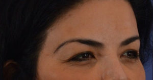 Blepharoplasty