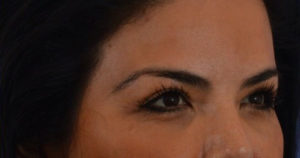 Blepharoplasty