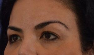 Blepharoplasty