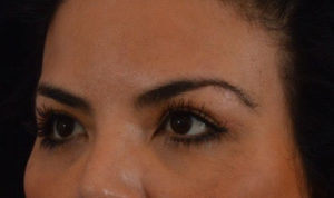 Blepharoplasty