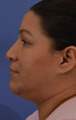 Rhinoplasty