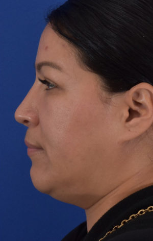 Rhinoplasty