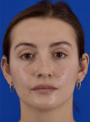 Rhinoplasty