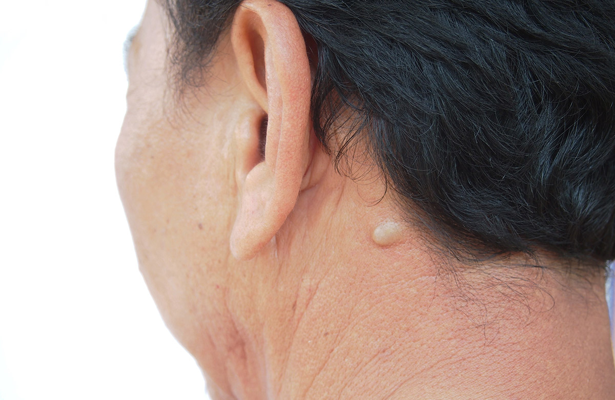 Sebaceous cyst on a man's neck