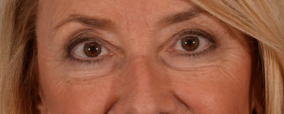 Blepharoplasty Results Newport Beach