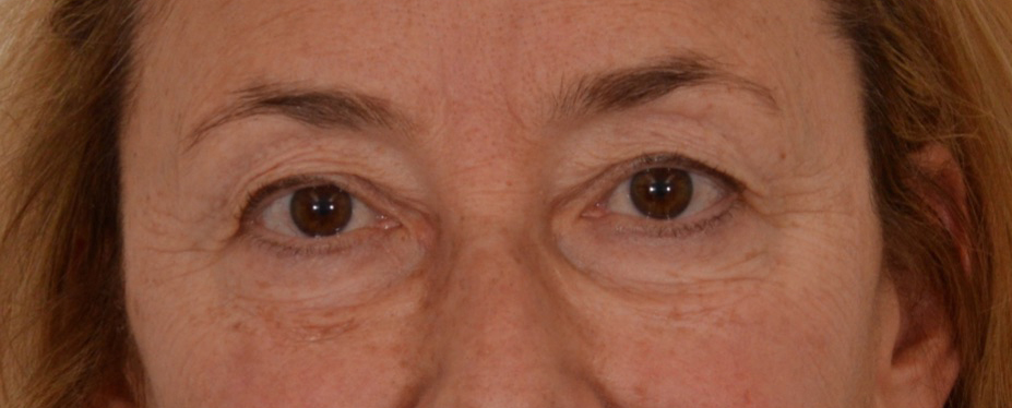 Blepharoplasty Results Newport Beach