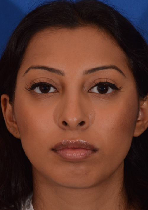 Chin Augmentation Results NewPort Beach