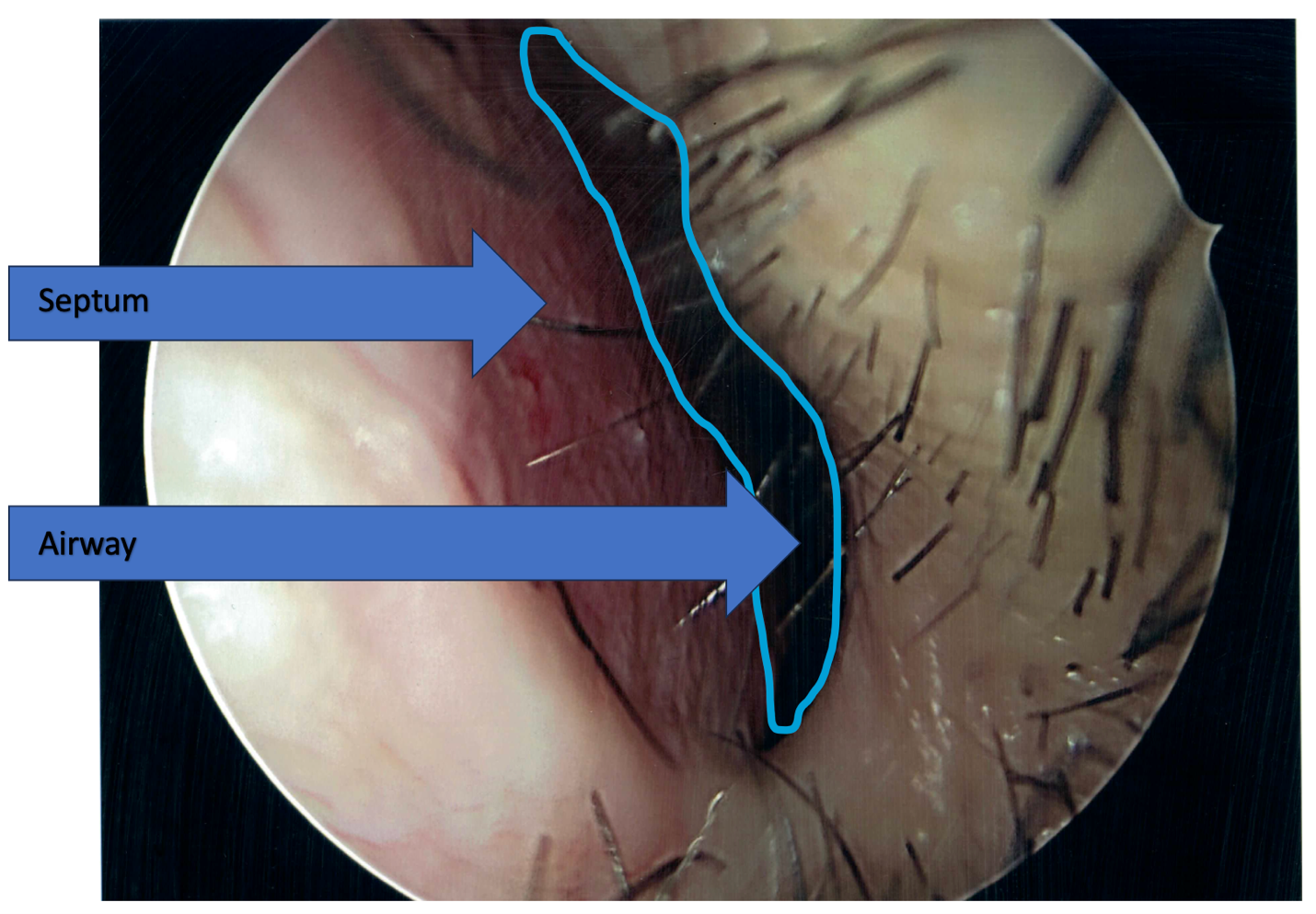 Septoplasty and Turbinate Surgery