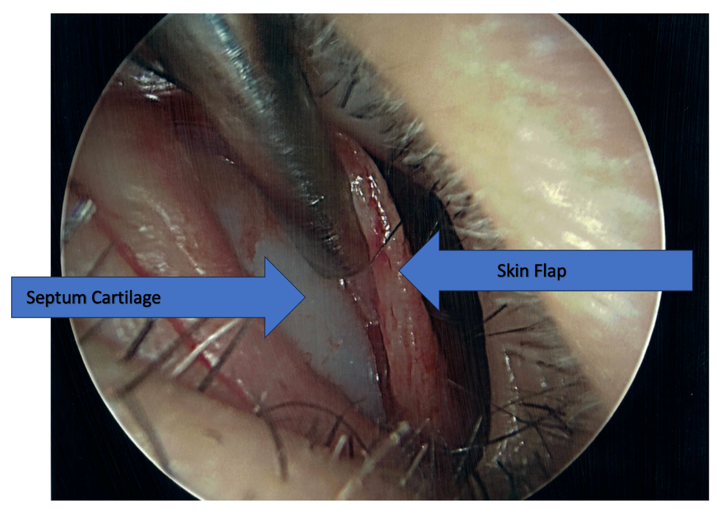 Septoplasty and Turbinate Surgery