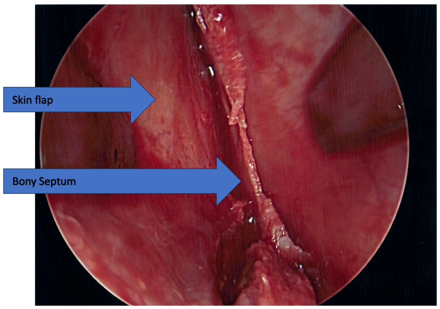 Septoplasty and Turbinate Surgery