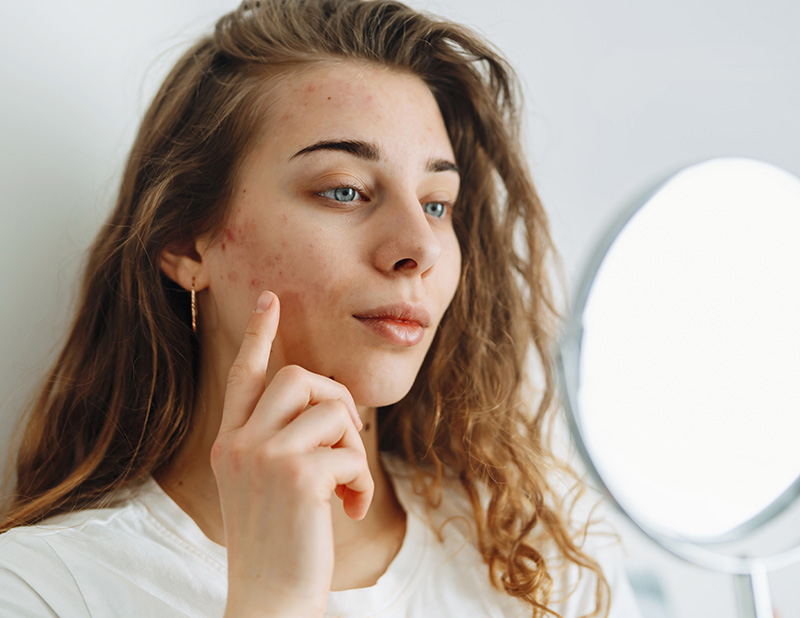 acne on woman's face with rash skin and scars